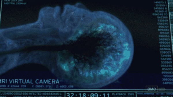 Walking Dead MRI brain scan