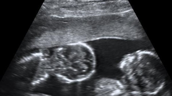 Monoamniotic Twins Scan At 15 Weeks