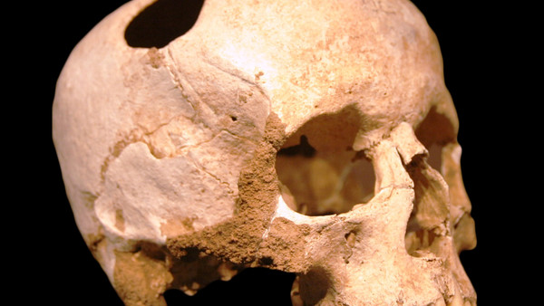 Cranial Trepanning