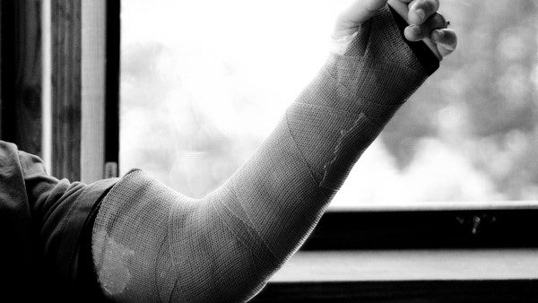 Broken Arm In Cast