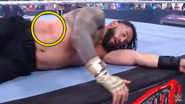 Roman Reigns Bruise